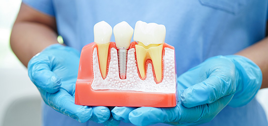 ¿Por qué elegir un seguro dental que cubre implantes?