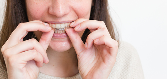 ¿El seguro dental me cubre la ortodoncia invisible Invisalign?